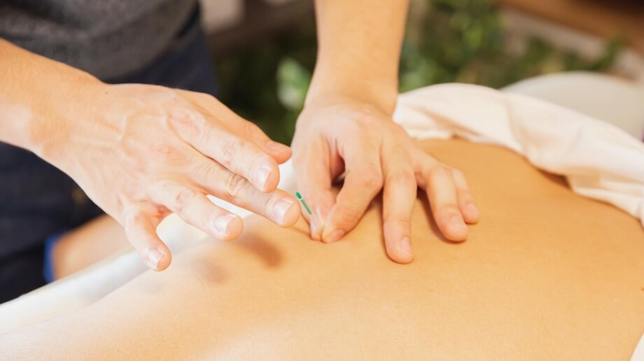 Inserting Needles in the Back - Acupuncture